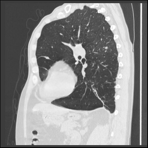 File:Alpha-1-antitrypsin deficiency (Radiopaedia 40993-43722 Sagittal lung window 104).jpg