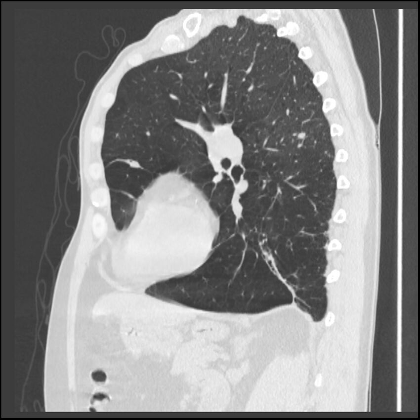 Alpha-1-antitrypsin deficiency (Radiopaedia 40993-43722 Sagittal lung window 104).jpg