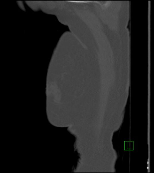 File:Amiodarone deposition in the liver (Radiopaedia 77587-89780 Sagittal bone window 97).jpg