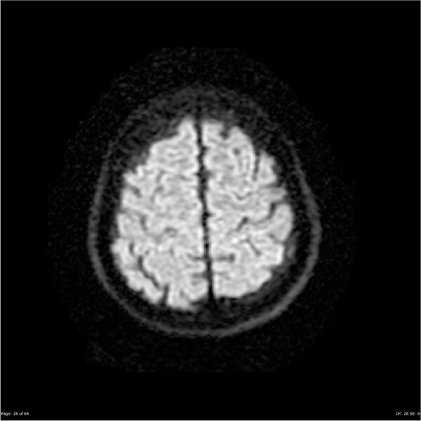 File:Amnestic syndrome secondary to hypoxic brain injury (Radiopaedia 24743-25004 DWI 26).jpg