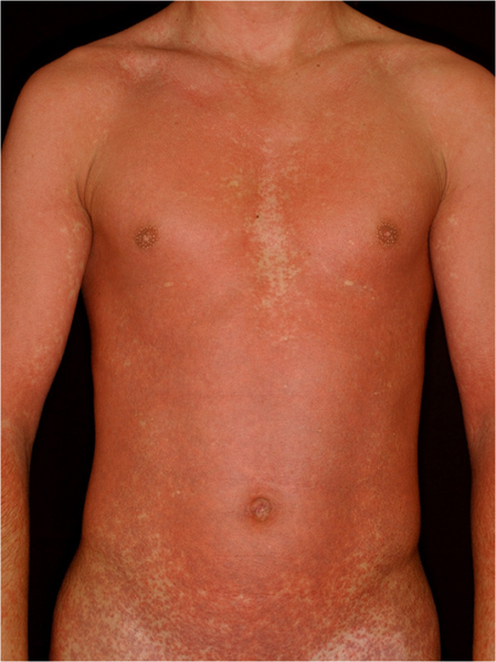 File:Amoxicillin rash in a patient with infectious mononucleosis.png