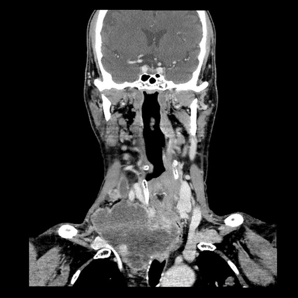 File:Anaplastic thyroid carcinoma (Radiopaedia 79087-92034 A 60).jpg