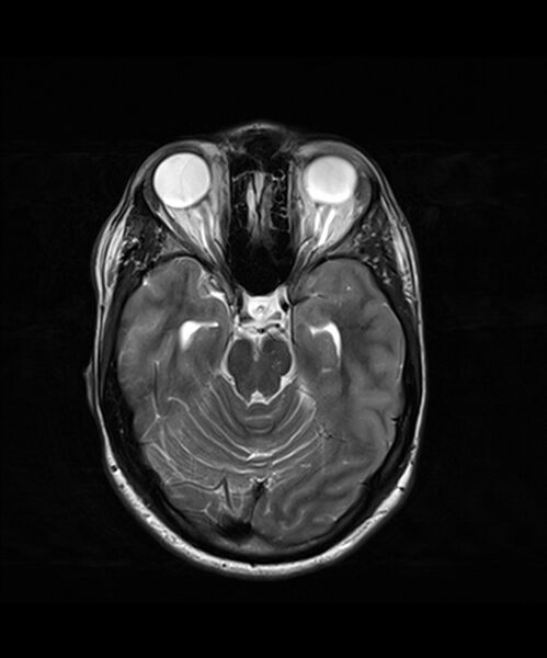 File:Angiomatous meningioma (Radiopaedia 79459-92577 Axial T2 11).jpg