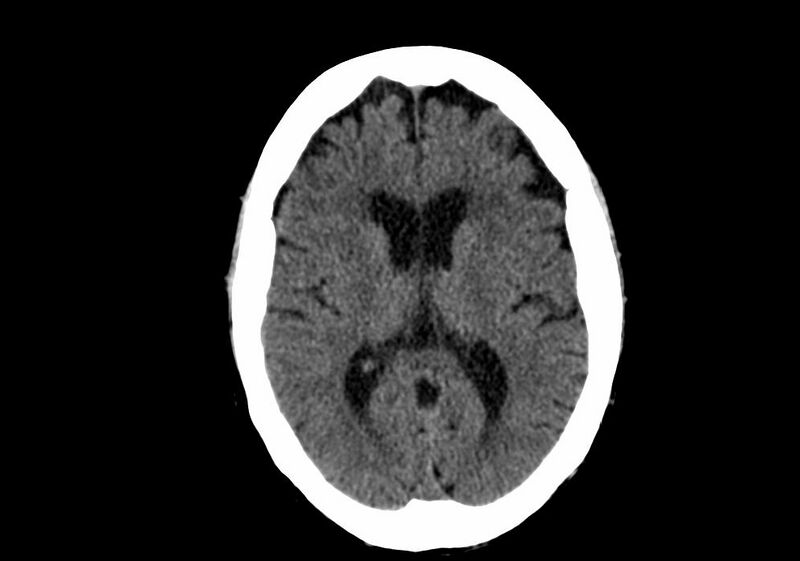 File:Anomalous intracranial venous drainage (Radiopaedia 28161-28418 Axial non-contrast 24).jpg