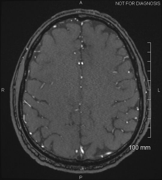 File:Anterior cerebral artery aneurysm (Radiopaedia 80683-94127 Axial MRA 183).jpg