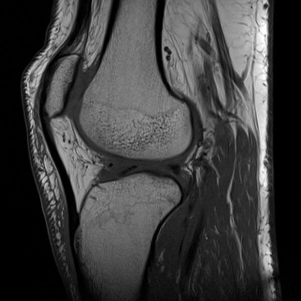 File:Anterior cruciate ligament tear - ramp lesion (Radiopaedia 71883-82322 Sagittal T1 10).jpg