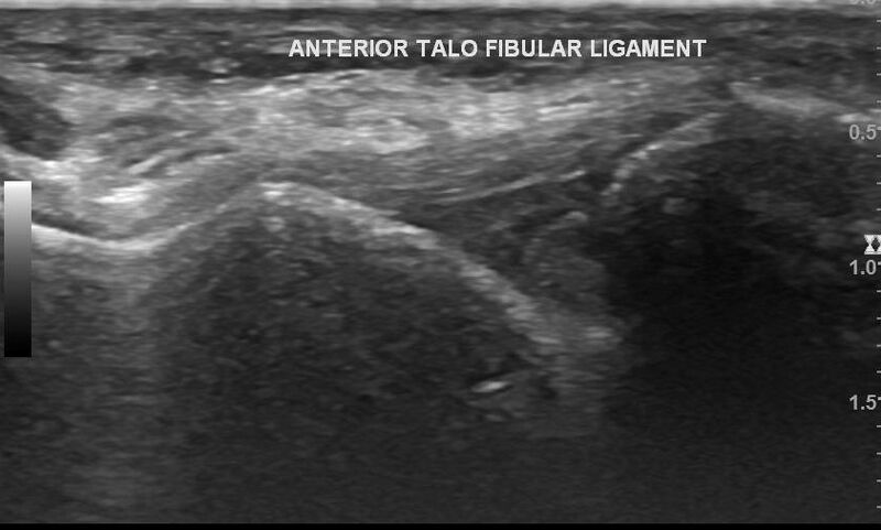 File:Anterior inferior tibiofibular ligament injury (Radiopaedia 65077-74073 Longitudinal 1).jpg