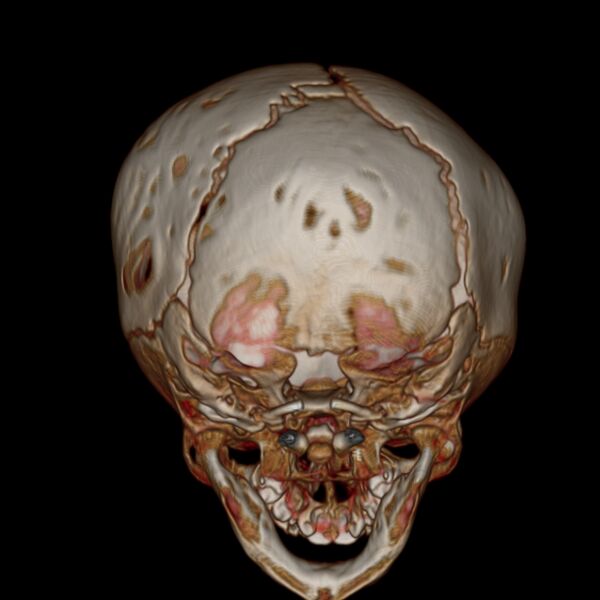 File:Anterior plagiocephaly (Radiopaedia 71836-82273 E 14).jpg