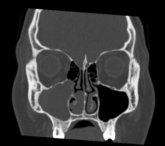 File:Antrochoanal polyp (Radiopaedia 21894-21868 Coronal bone window 12).jpg