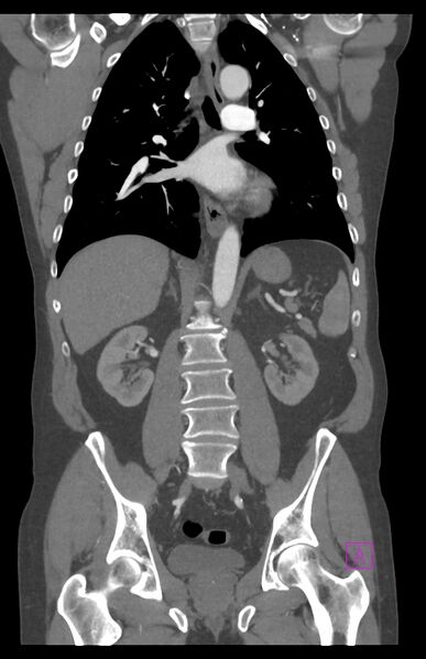 File:Aortectomy and axillary-bifemoral bypass (Radiopaedia 28303-28545 C 55).jpg