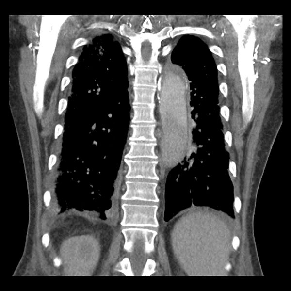 File:Aortic arch graft infection (FDG PET-CT) (Radiopaedia 71975-82437 Coronal 46).jpg