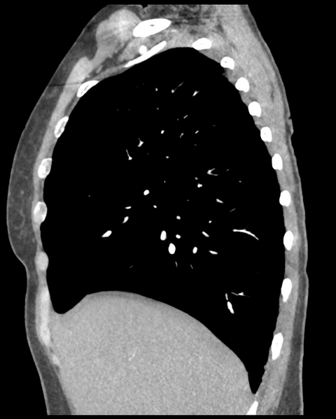 File:Aortic valve non-coronary cusp thrombus (Radiopaedia 55661-62189 D 39).png