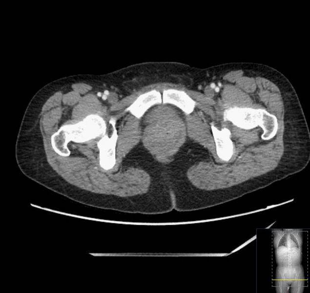 File:Appendicitis (CT angiogram) (Radiopaedia 154713-127660 Axial 84).jpg