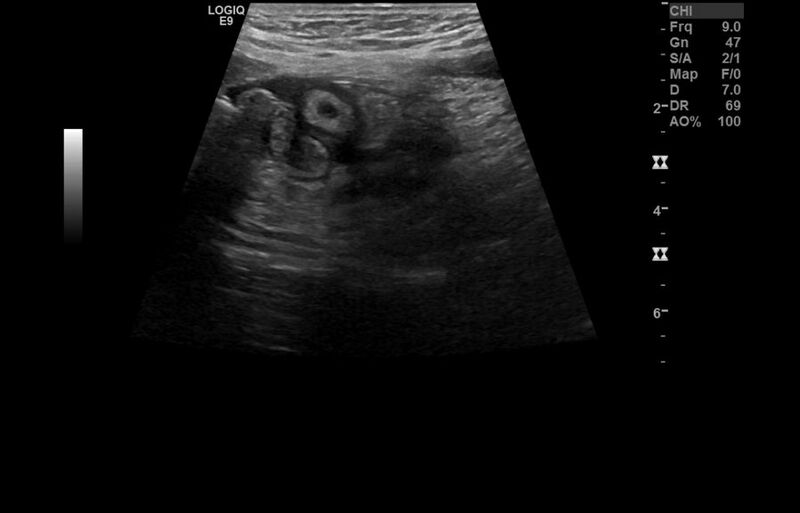 File:Appendicitis and incidental foregut duplication cyst (Radiopaedia 52962-58918 A 10).jpg