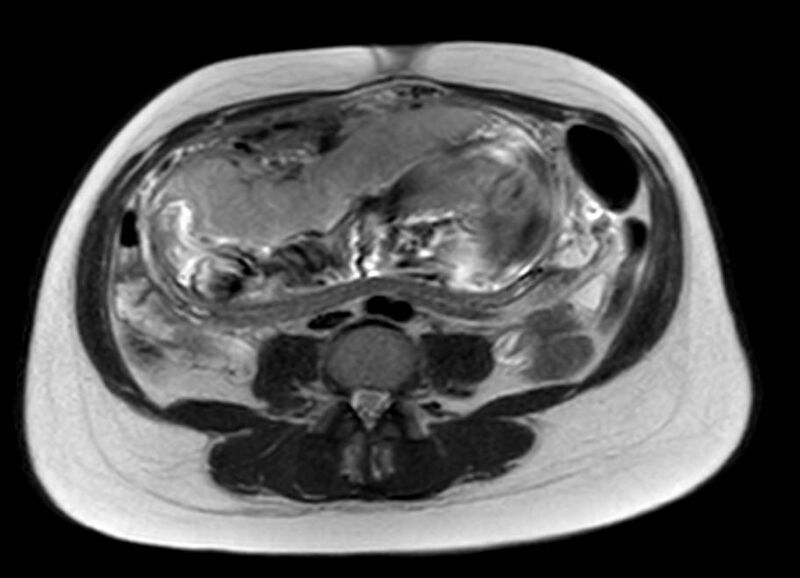 File:Appendicitis in gravida (MRI) (Radiopaedia 89433-106395 Axial T2 39).jpg