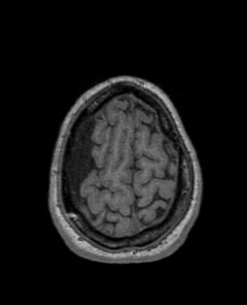 File:Arachnoid cyst- extremely large (Radiopaedia 68741-78451 Axial T1 69).jpg