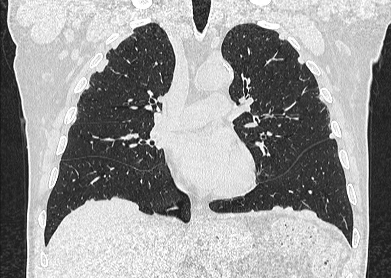 File:Asbestos pleural placques (Radiopaedia 57905-64872 Coronal lung window 132).jpg