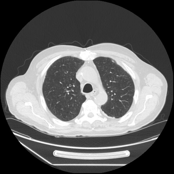 File:Asbestosis complicated by lung cancer (Radiopaedia 45834-50116 Axial lung window 20).jpg