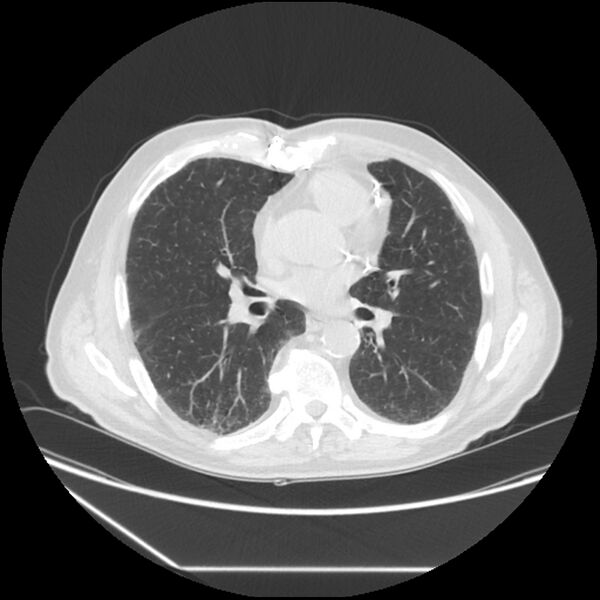 File:Asbestosis complicated by lung cancer (Radiopaedia 45834-50116 Axial lung window 37).jpg