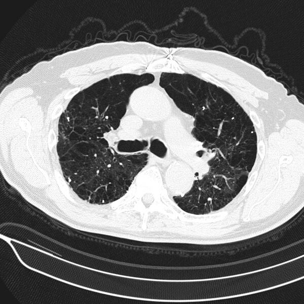 File:Aspergilloma (Radiopaedia 24521-24804 Axial lung window 7).jpg