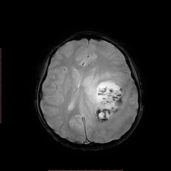 File:Astroblastoma (Radiopaedia 74287-85162 Axial SWI 13).jpg