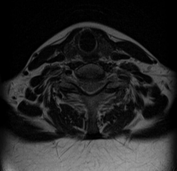 File:Astrocytoma - spinal cord (Radiopaedia 69769-79758 Axial T2 16).jpg