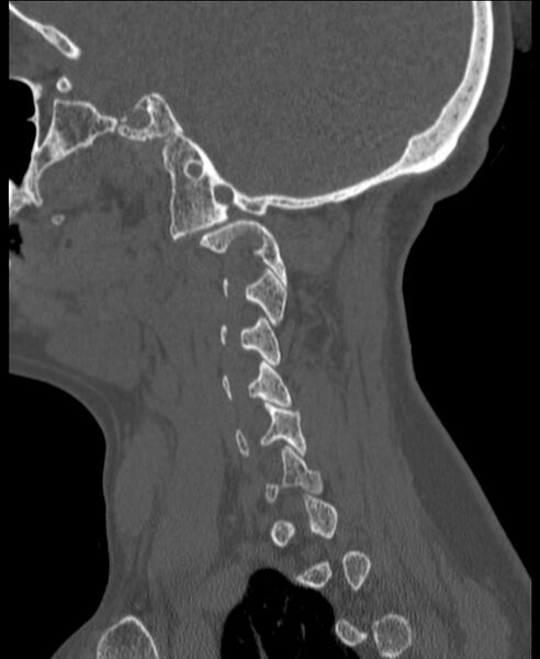 File:Atlanto-occipital assimilation with basilar invagination (Radiopaedia 70122-80188 Sagittal bone window 6).jpg