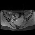 Atypical deep infiltrating endometriosis (Radiopaedia 44470-48125 Axial T1 fat sat 10).jpg