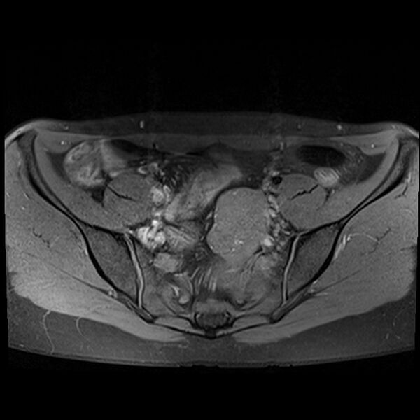File:Atypical deep infiltrating endometriosis (Radiopaedia 44470-48125 Axial T1 fat sat 6).jpg