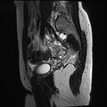 Atypical deep infiltrating endometriosis (Radiopaedia 44470-48125 Sagittal T2 4).jpg