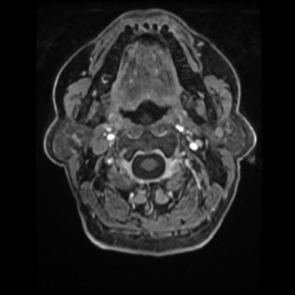 File:Atypical meningioma (Radiopaedia 45535-49629 Axial T1 C+ 7).jpg