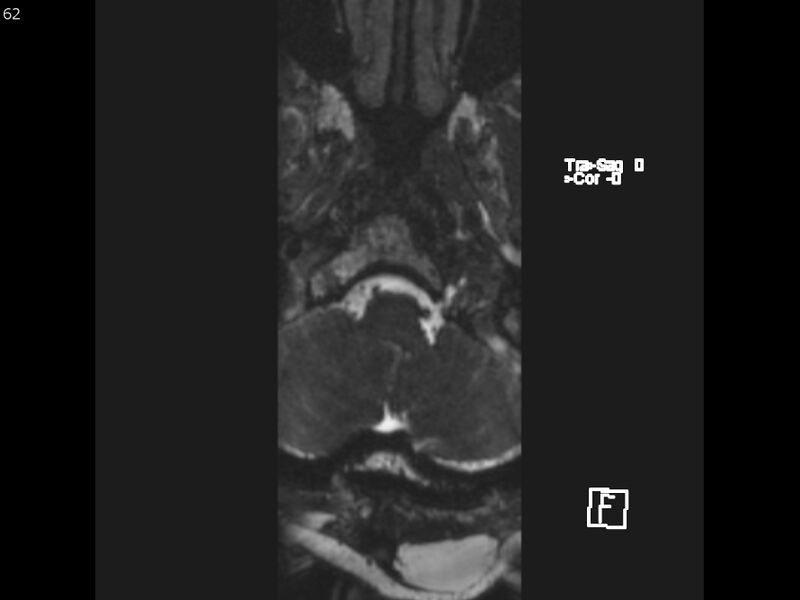File:Atypical meningioma - intraosseous (Radiopaedia 64915-74572 Axial CISS 62).jpg
