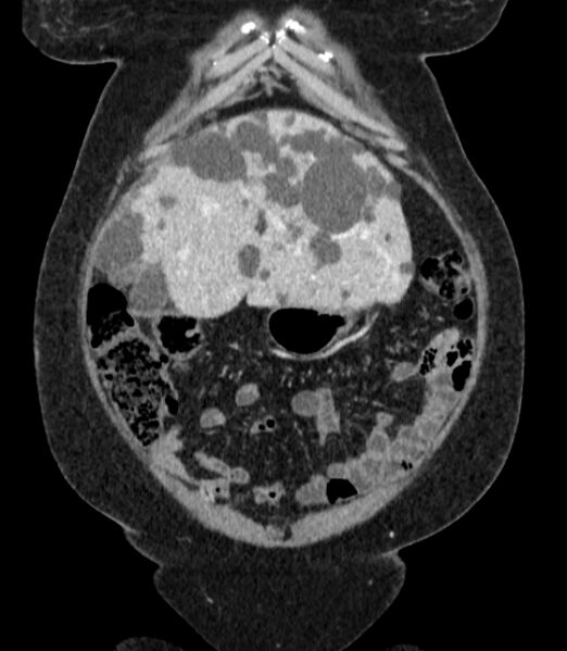 File:Autosomal dominant polycystic kidney disease (Radiopaedia 57124-64017 B 15).jpg