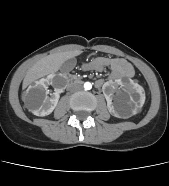 File:Autosomal dominant polycystic kidney disease - early onset (Radiopaedia 40734-43387 B 35).jpg