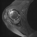 Avulsion fracture - greater tuberosity of humerus (Radiopaedia 71216-81515 Axial PD fat sat 10).jpg