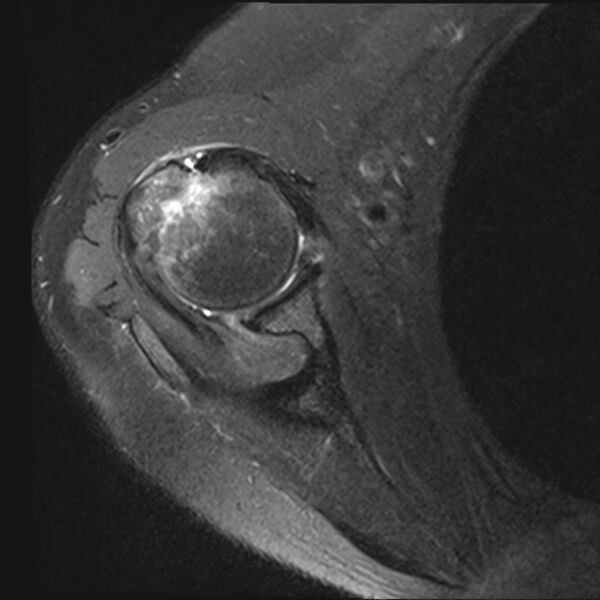 File:Avulsion fracture - greater tuberosity of humerus (Radiopaedia 71216-81515 Axial PD fat sat 10).jpg