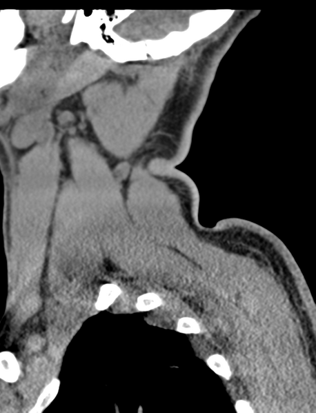 File:Axis peg fracture (type 3) and atlas lateral mass (type 4) fracture (Radiopaedia 37474-39324 D 2).png