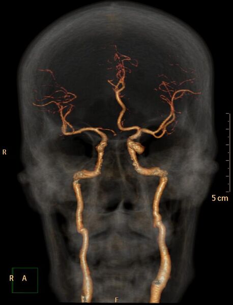 File:Azygos anterior cerebral artery (Radiopaedia 30805-31512 B 1).jpg