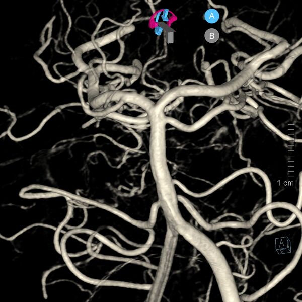 File:Basilar artery perforator aneurysm (Radiopaedia 82455-97734 3D view left VA 39).jpg