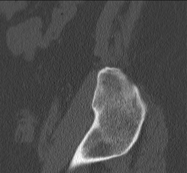 File:Bertolotti syndrome (Radiopaedia 24864-25128 Sagittal bone window 57).jpg
