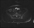 Bicornuate bicollis uterus (Radiopaedia 61626-69616 Axial PD fat sat 4).jpg