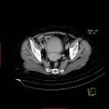 Bifid ureter (Radiopaedia 47604-52253 Axial C+ delayed 25).jpg