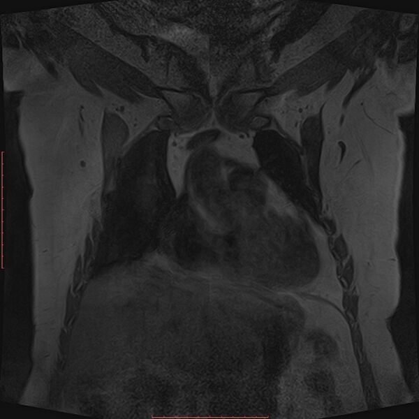 File:Bilateral breast implant rupture (Radiopaedia 24761-25027 G 4).jpg