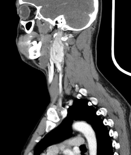 File:Bilateral carotid body tumors (Radiopaedia 52899-58827 C 41).jpg