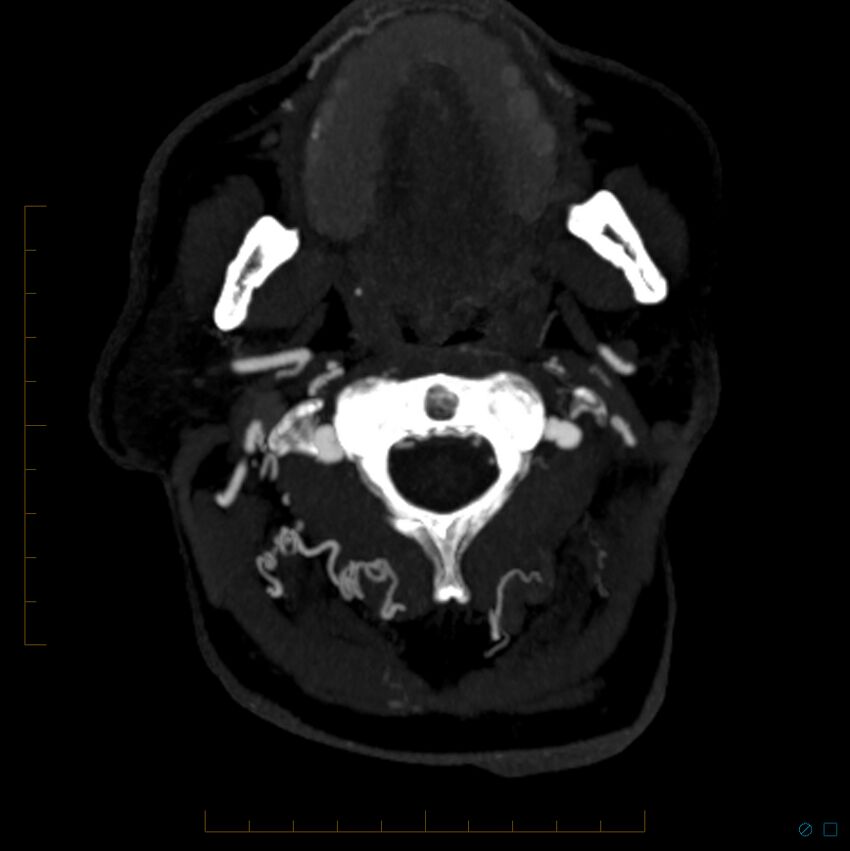 Bilateral chronic common carotid occlusion (Radiopaedia 50849-56362 D 32).jpg