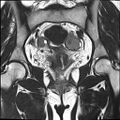 Bilateral ovarian endometriomas (Radiopaedia 87085-103347 Coronal T2 12).jpg