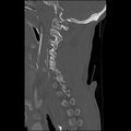 Bilateral perched facets with cord injury (Radiopaedia 45587-49713 Sagittal bone window 17).jpg