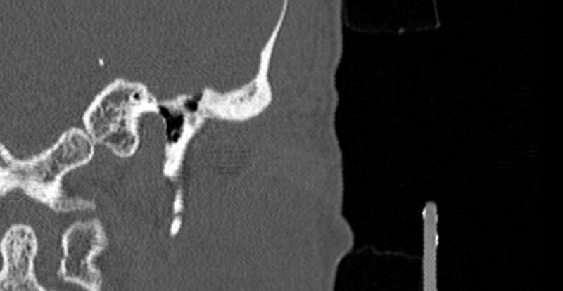 File:Bilateral temporal bone fractures (Radiopaedia 29482-29970 B 2).jpg