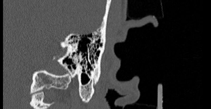 File:Bilateral temporal bone fractures (Radiopaedia 29482-29970 B 74).jpg