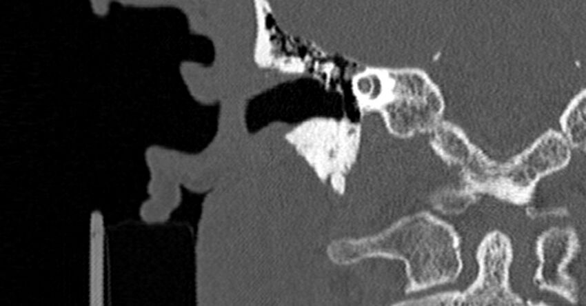 Bilateral temporal bone fractures (Radiopaedia 29482-29970 Coronal non-contrast 96).jpg